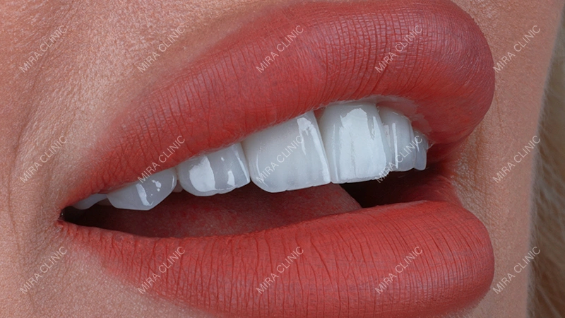 Hollywood Smile